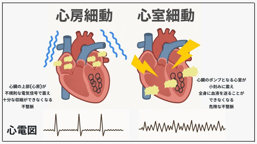 図解 心房細動と心室細動の違い